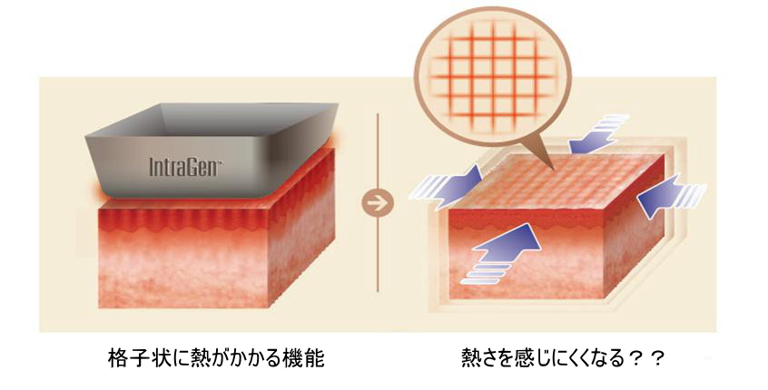イントラジェンのGFRは網目状に熱をかける機構