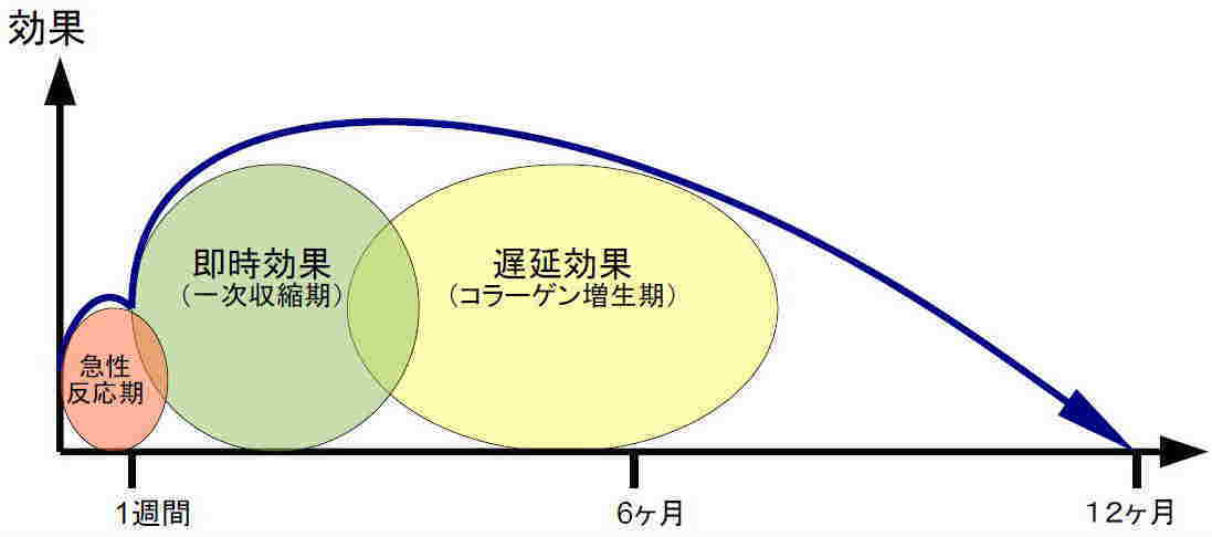 サーマクールの即時効果～速効性はあるか～