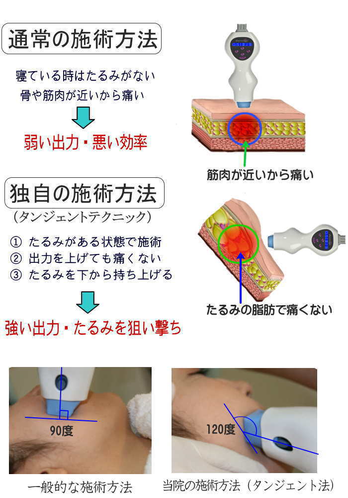 6.サーマクールの効果が違う理由～打ち方の違い～